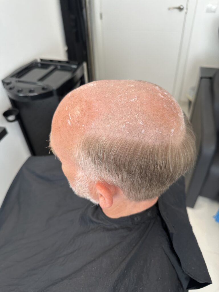 Men's Hair Systems example 2