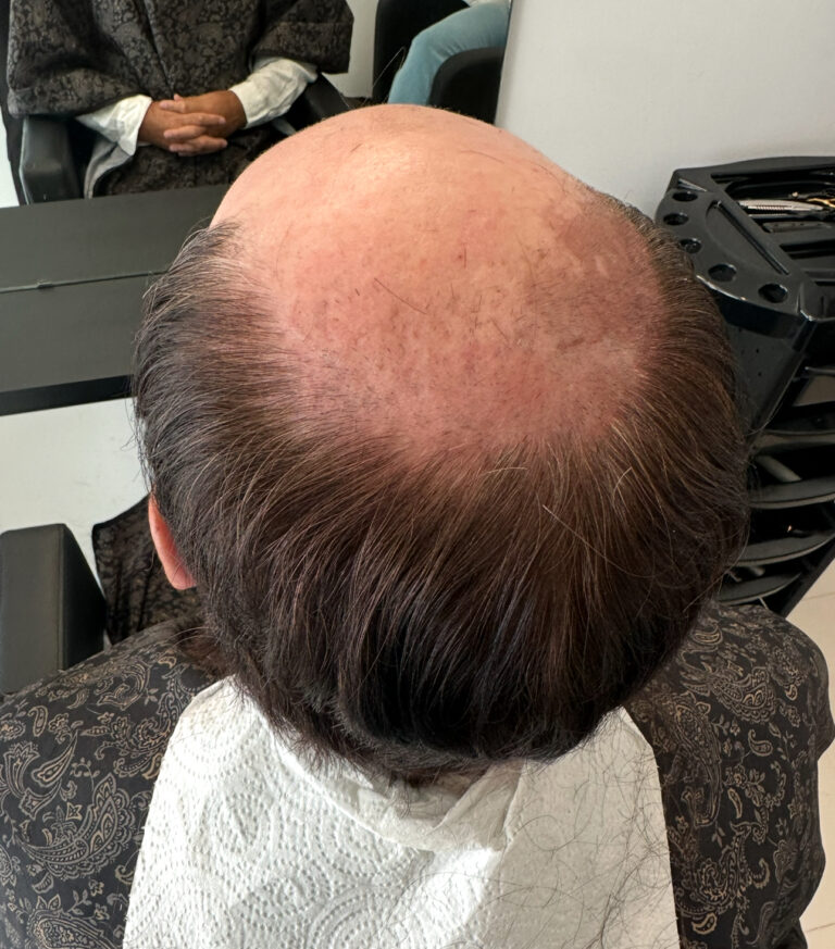 Men's Hair Systems example 4